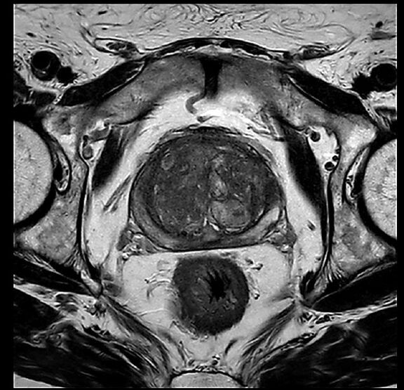 MRT Aufnahme Prostata - transversal