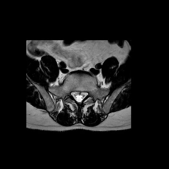 MRT Aufnahme Lendenwirbelsäule (LWS) - transversal
