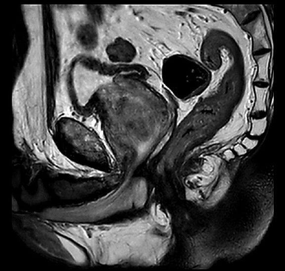 MRT Aufnahme Prostata - sagittal