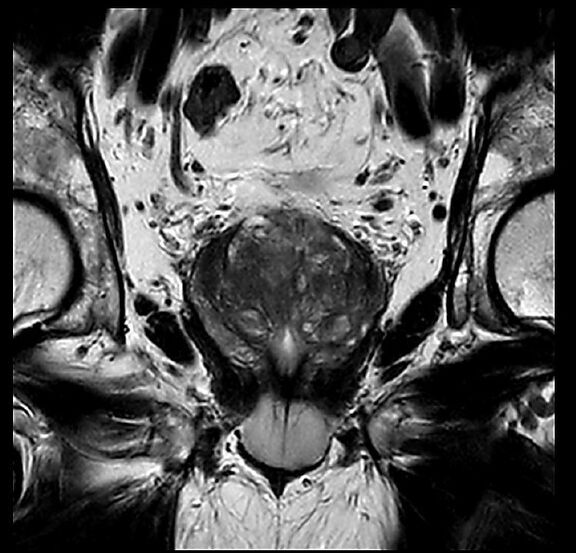 MRT Aufnahme Prostata - koronar