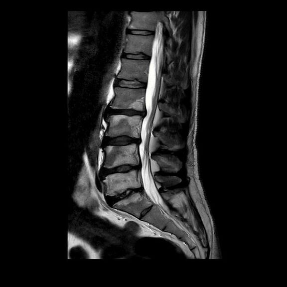 MRT Aufnahme Lendenwirbelsäule (LWS) - sagittal