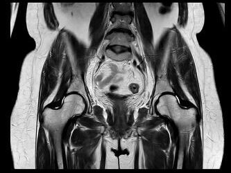 MRT Aufnahme Becken - koronar