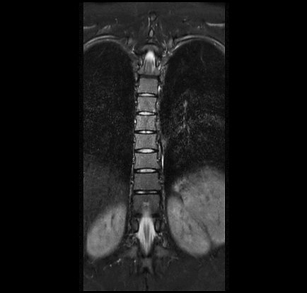 MRT Aufnahme Brustwirbelsäule (BWS) - koronar
