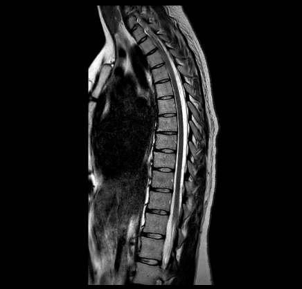 MRT Aufnahme Brustwirbelsäule (BWS) - sagittal