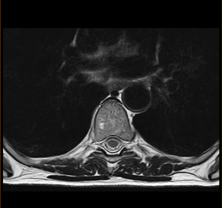 MRT Aufnahme Brustwirbelsäule (BWS) - transversal