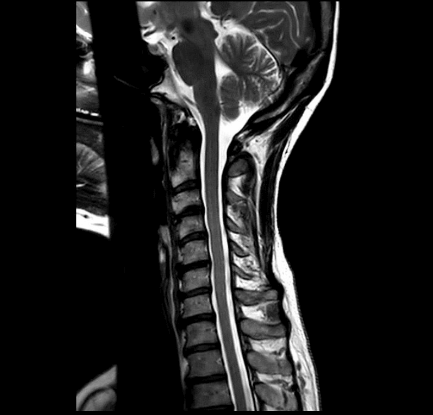 MRT Aufnahme Halswirbelsäule (HWS) - sagittal