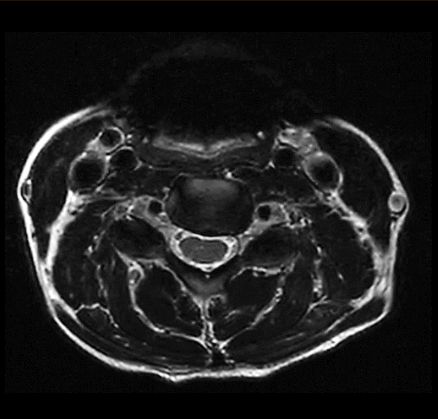 MRT Aufnahme Halswirbelsäule (HWS) - tranversal